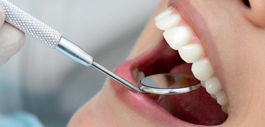 White Fillings
